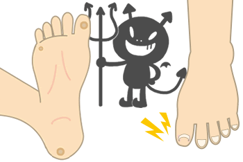 足にできたウイルス性のイボの原因と種類